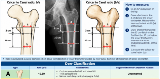 Dorr Classification – Cemented vs UnCemented Total Hip Arthroplasty