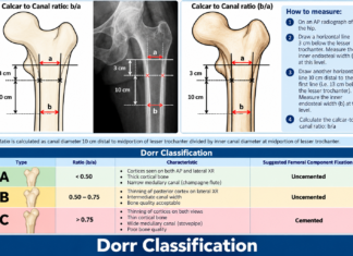 Dorr Classification – Cemented vs UnCemented Total Hip Arthroplasty