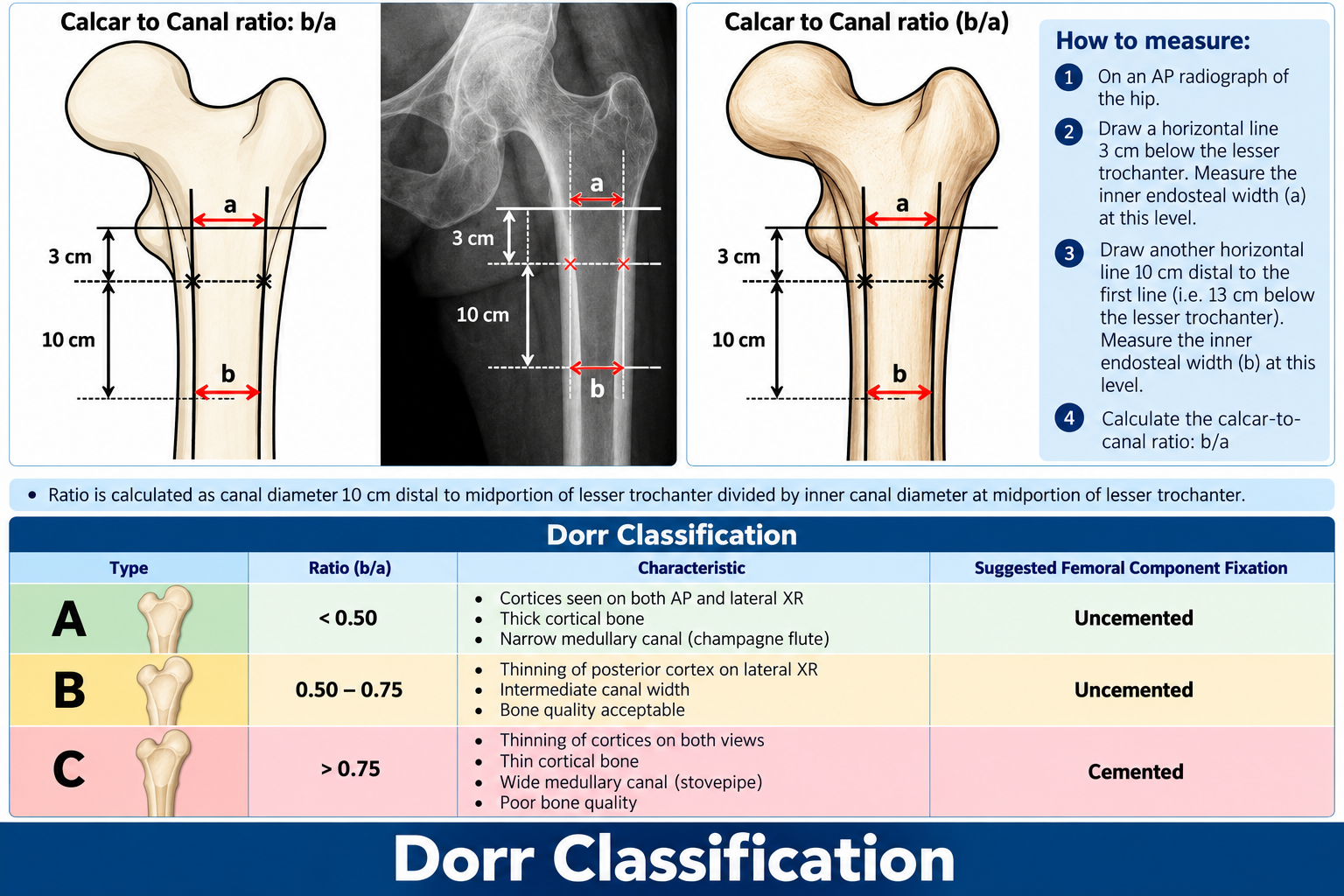 Dorr Criteria / Dorr Classification