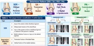 Lauge Hansen Classification for Ankle Fracture (Make it Easy)